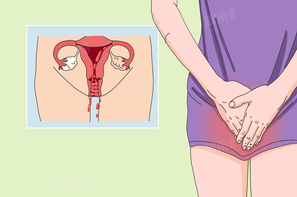 علائم زگیل تناسلی زنان