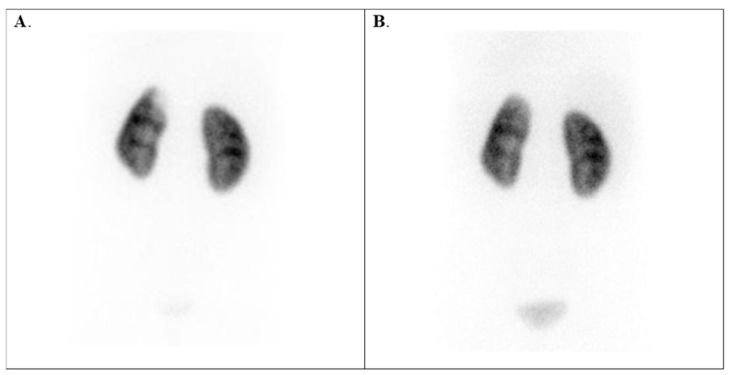 اسکن DMSA اسکن DMSA چیست