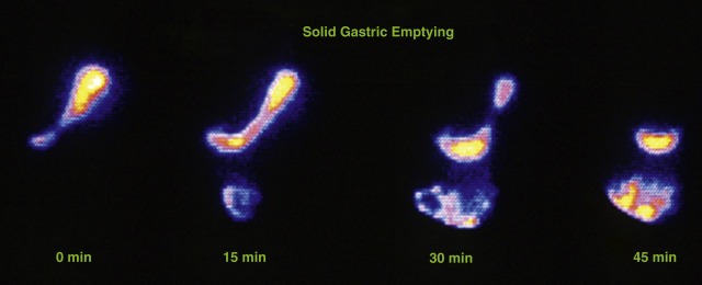 مزایای اسکن هسته ای معده مزایای اسکن هسته ای معده