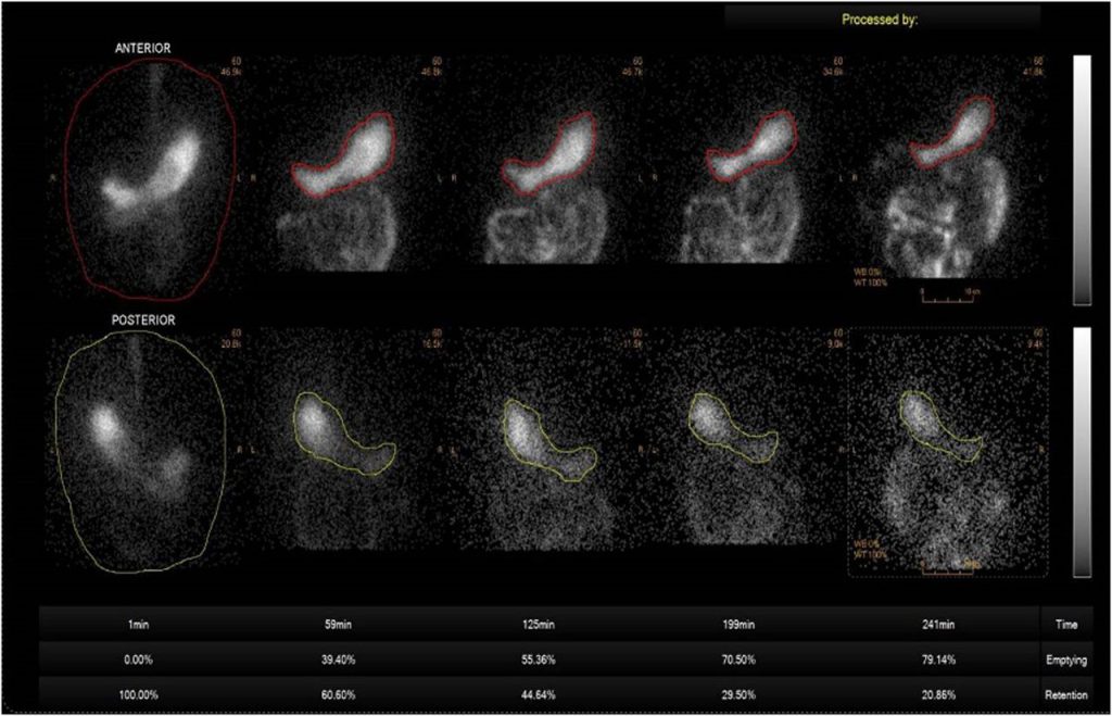 کاربرد اسکن هسته ای معده کاربردهای اسکن هسته ای معده