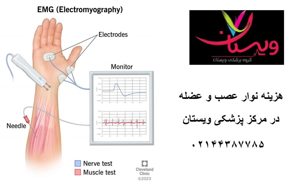 هزینه نوار عصب و عضله آزاد چقدر است؟ تعرفه 1404 EMG ویستان