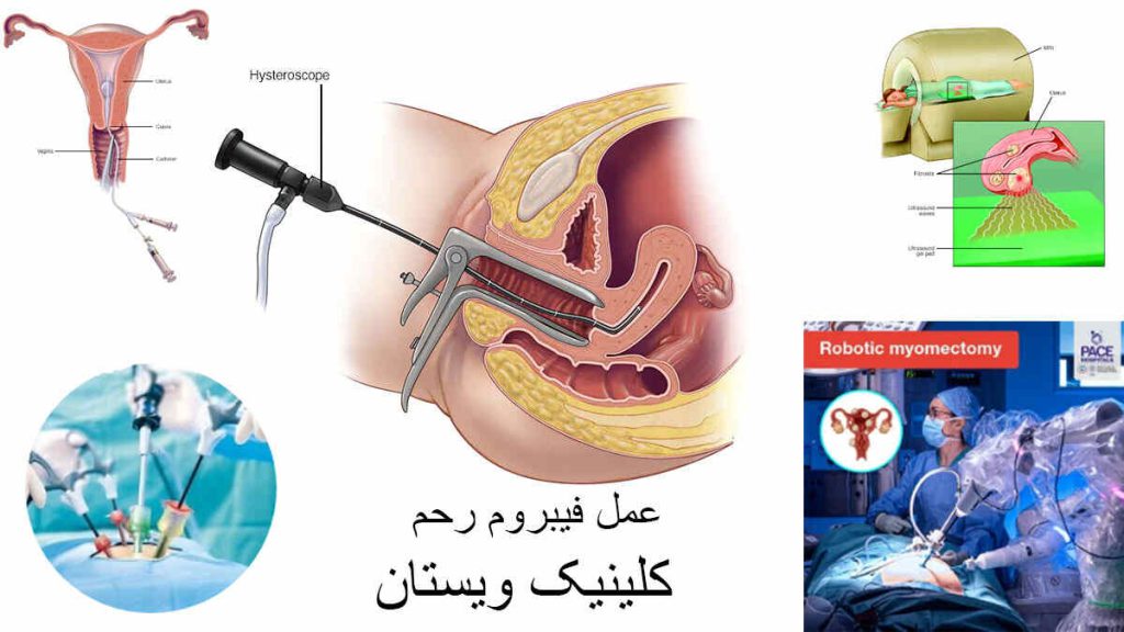 هزینه عمل فیبروم رحم با لیزر هزینه عمل فیبروم رحم با لیزر