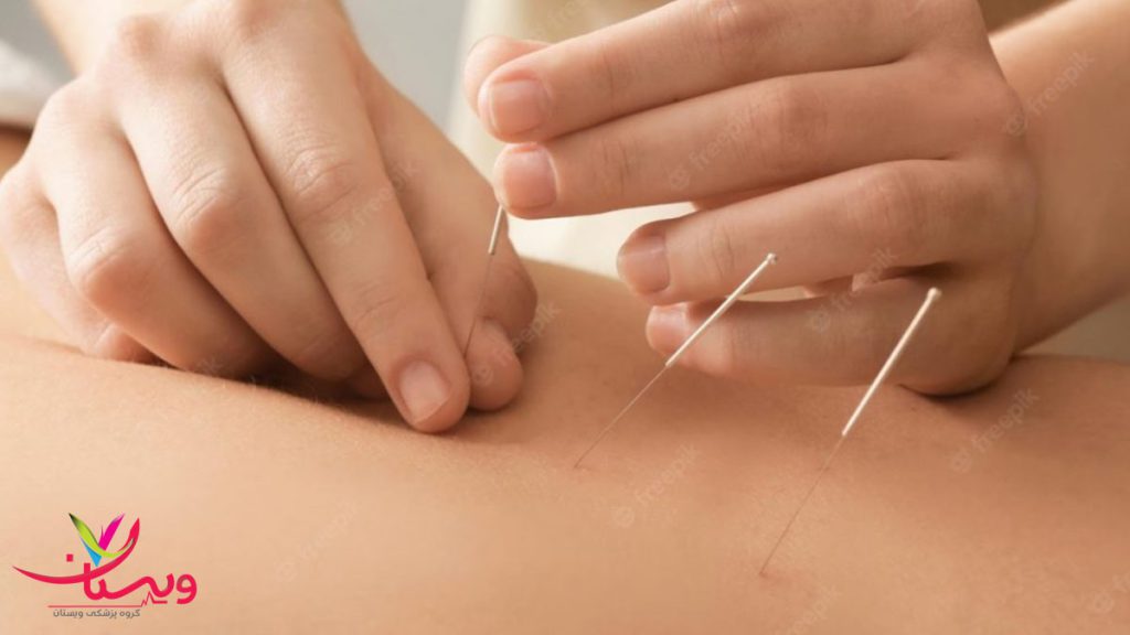 بهترین دکتر امبدینگ غرب تهران بهترین دکتر امبدینگ غرب تهران