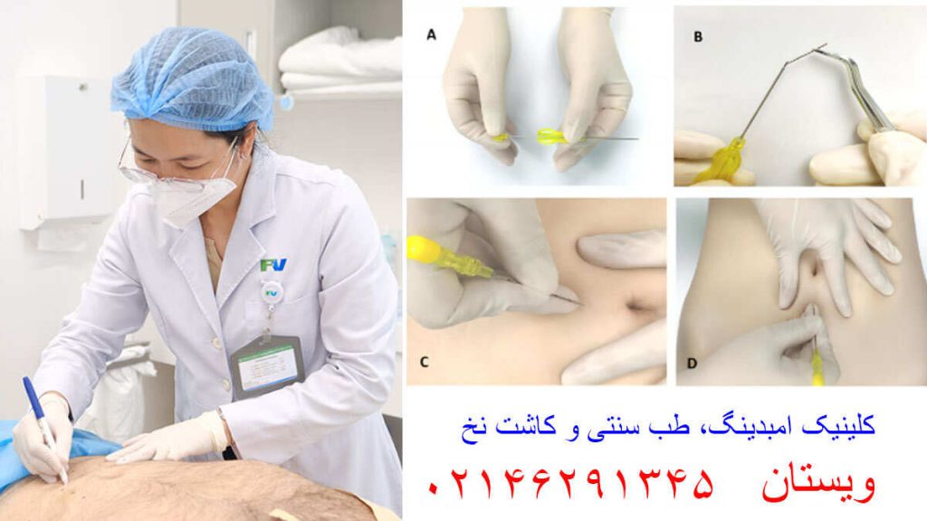 بهترین دکتر امبدینگ غرب تهران بهترین دکتر امبدینگ غرب تهران