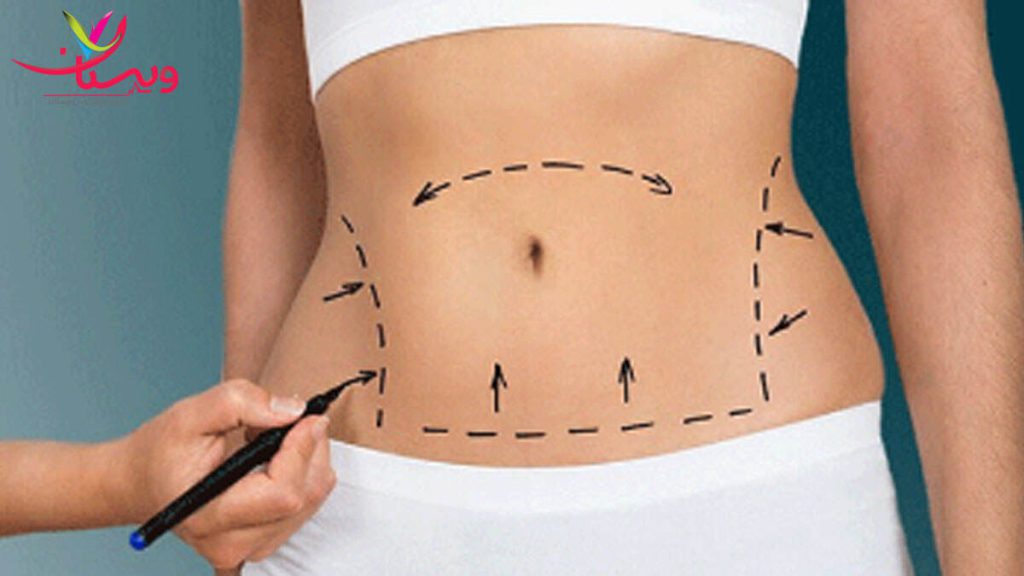 بهترین دکتر امبدینگ غرب تهران بهترین دکتر امبدینگ غرب تهران