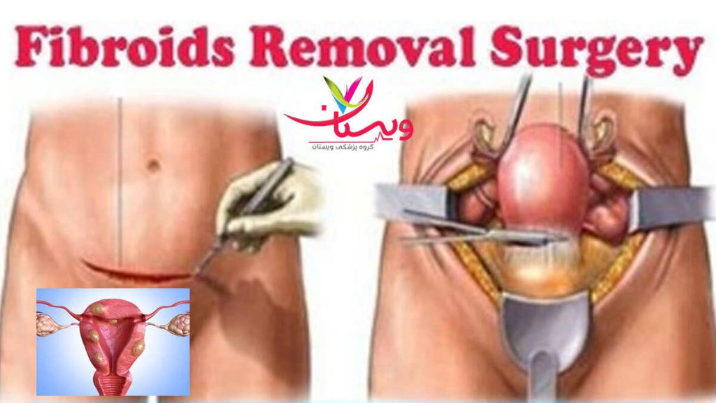 عوامل موثر بر هزینه عمل فیبروم رحم عوامل موثر هزینه عمل فیبروم رحم