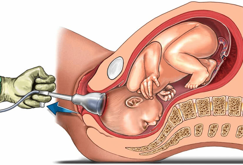 مزایا و معایب زایمان طبیعی مزایا و معایب زایمان طبیعی
