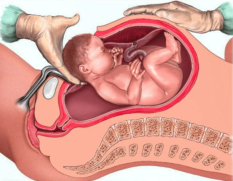 مزایا و معایب سزارین مزایا و معایب سزارین