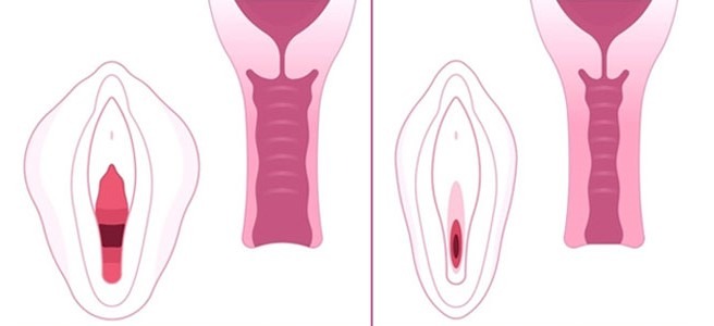 مزایای واژینوپلاستی در بهبود کیفیت زندگی