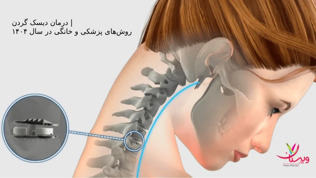 استفاده از گردنبند طبی (بریس گردنی) برای درمان دیسک گردن استفاده از گردنبند طبی (بریس گردنی) برای درمان دیسک گردن