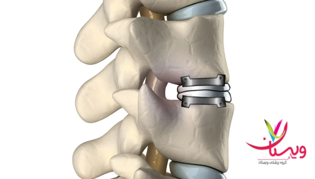 هزینه درمان دیسک گردن در سال ۱۴۰۴ چقدر است؟ هزینه درمان دیسک گردن در سال ۱۴۰۴ چقدر است؟
