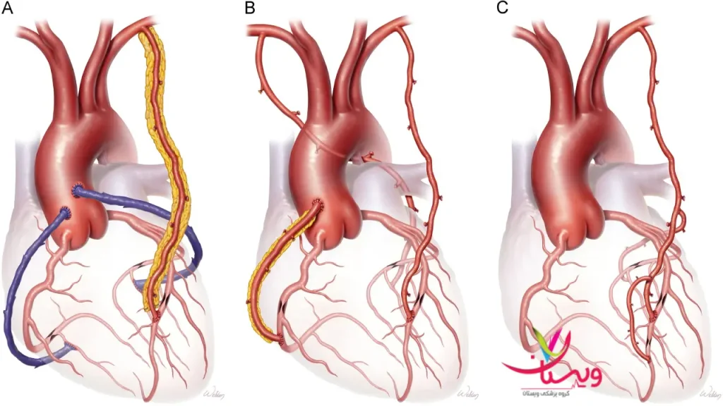 بررسی رگهای قلبی عوامل خطرساز سکته قلبی گذرا