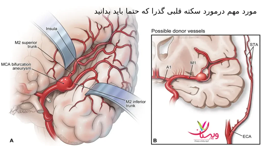 نکاتی که باید درمورد سکته قلبی گذرا بدانید