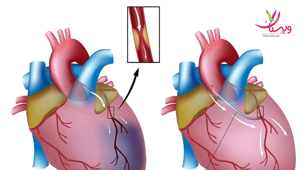 تفاوت قلب سالم با قلبی که دچار سکته شده سکته قلبی گذرا و سکته مغزی