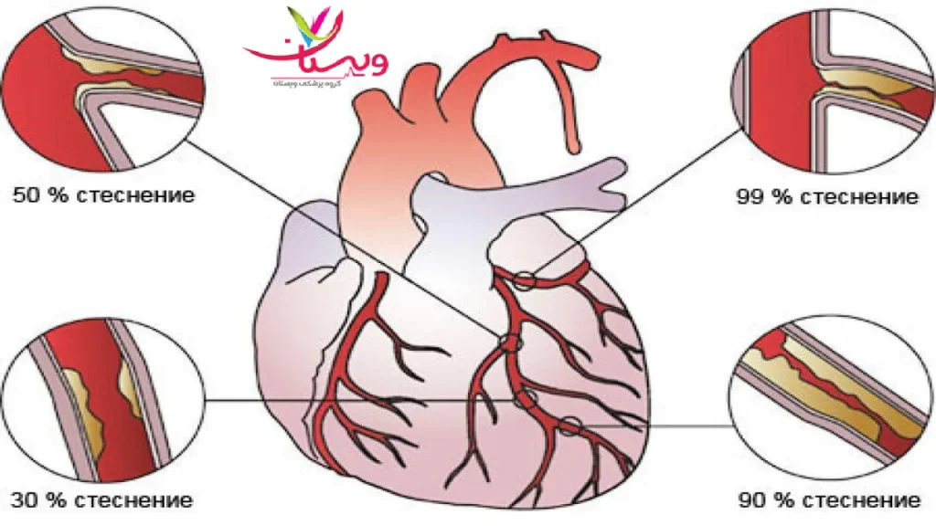 گرفتگی رگهای قلب درمان خانگی سکته قلبی گذرا