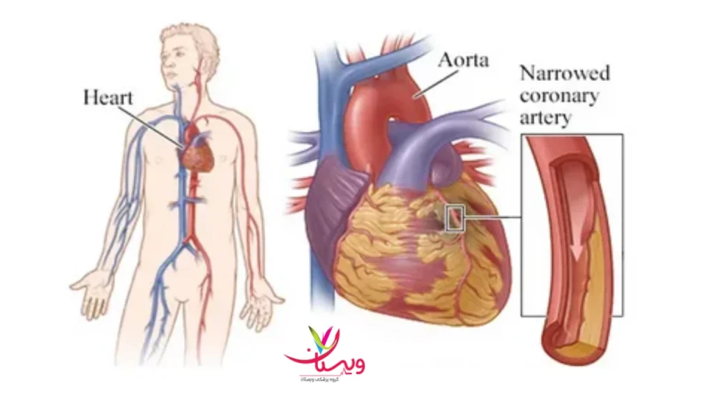 بررسی سکته قلبی درمان سکته قلبی گذرا