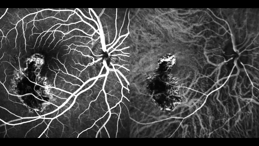 مزایا و محدودیتهای سیتی آنژیو عروق شکمی