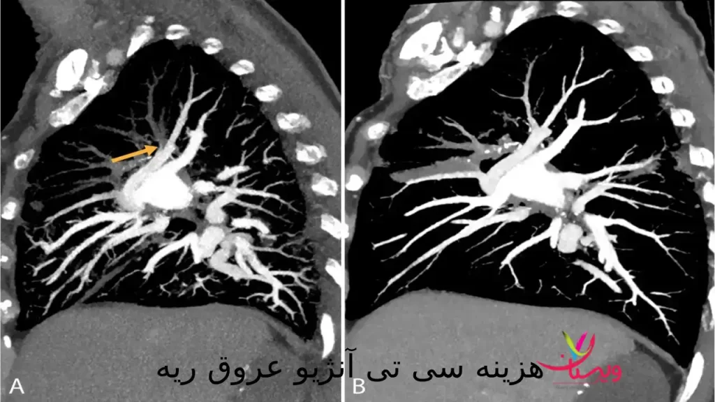 هزینه سی تی آنژیو عروق ریه| با بیمه و آزاد در 1404