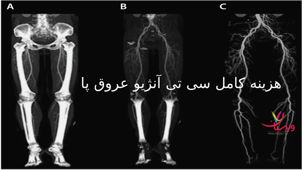 هزینه سی تی آنژیو عروق پا در 1404 به طور کامل با بیمه و آزاد