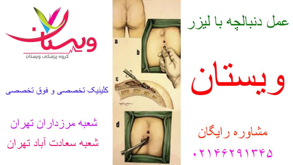 جزئیات عمل دنبالچه با لیزر عمل دنبالچه با لیزر